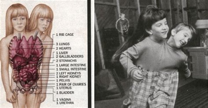 Tragic News: The Story Behind Abby And Brittany Hensel's Death