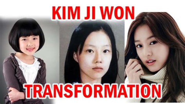Unveiling The Truth Behind Kim Ji Won's Plastic Surgery: A Comprehensive Analysis