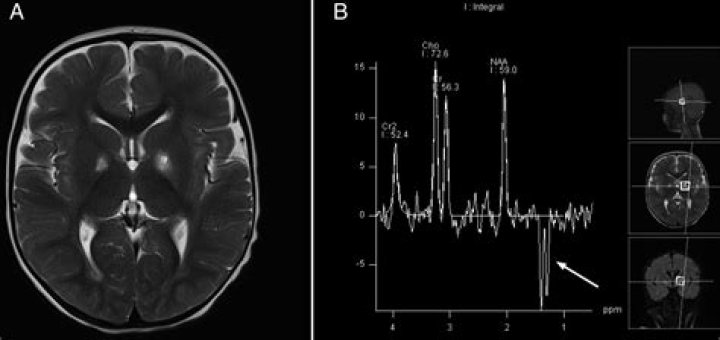 Leigh Keno's Inspiring Stroke Recovery Journey